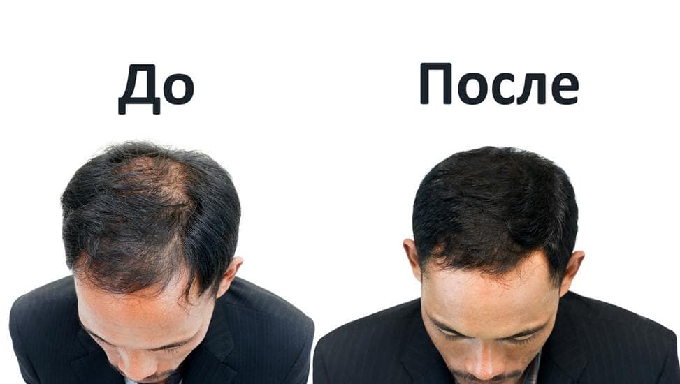 Лазерное лечение выпадения волос: до и после