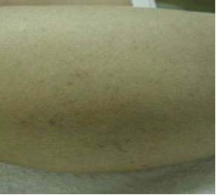 Удаление варикозных вен на ногах лазером: после процедуры